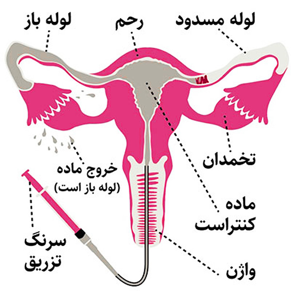 بررسی تخصصی عکس رنگی رحم (HSG)؛ ارزیابی ناباروری زنان